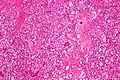 Micrograph of cerebellar hemangioblastoma. HPS stain.