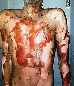 Crime scene photograph of Rainey's body in the prison infirmary right after his death. The white patches are material that staff used in efforts to revive him.