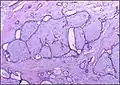 Histopathologic image of breast fibroadenoma showing proliferation of intralobular stroma compressing and distorting the epithelium. H&E stain.