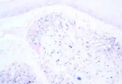 Image of human papillomavirus-associated oropharyngeal cancer, under a microscope. The tissue has been stained to show the presence of the virus by in situ hybridisation