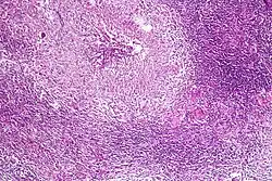Pulmonary tuberculosis featuring necrotizing granulomas, H&E stain.